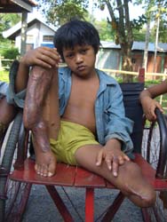 Cmc カンボジア地雷撤去キャンペーン 被害にあった子どもたち